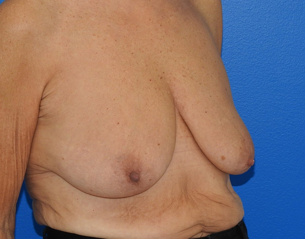 Before Image: Patient Case #0192 - right-front-oblique