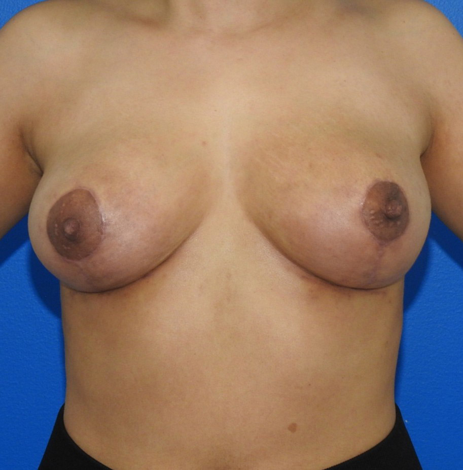 After Image: Patient Case #0193 - front