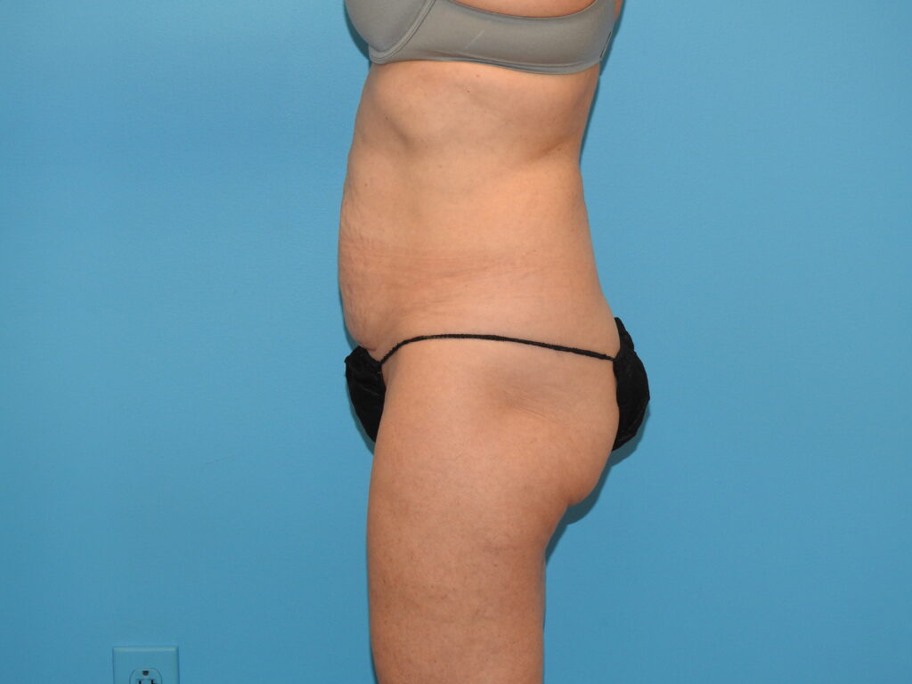 Before Image: Patient Case #0195 - left-side