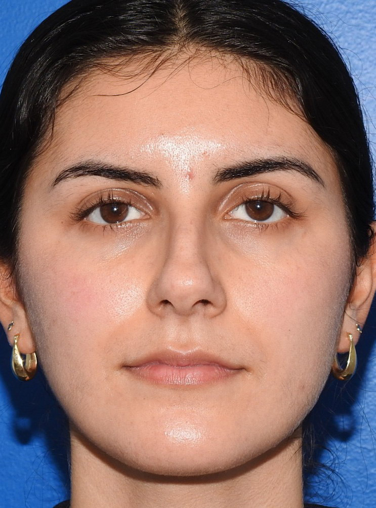 Before Image: Patient Case #0167 - front