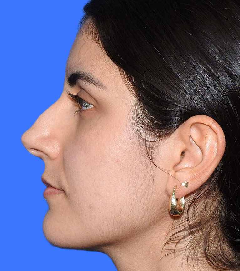 Before Image: Patient Case #0167 - left-side