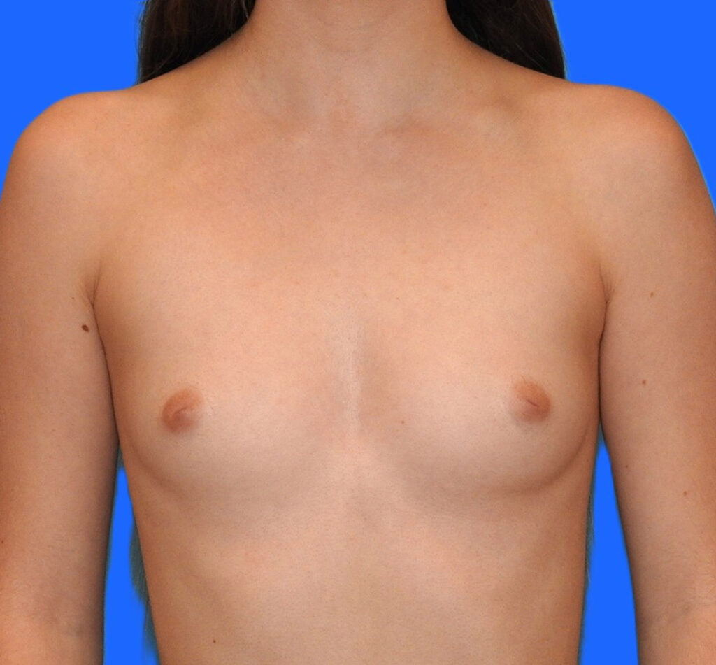 Before Image: Patient Case #0199 - front