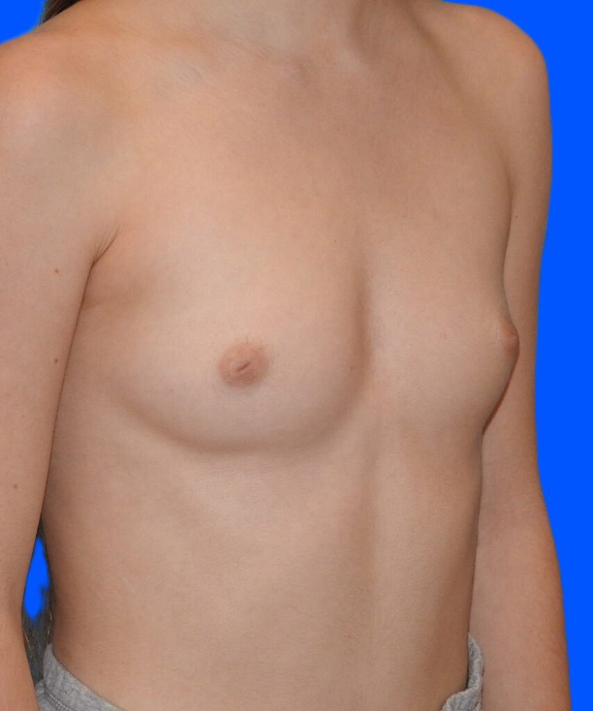 Before Image: Patient Case #0199 - right-front-oblique