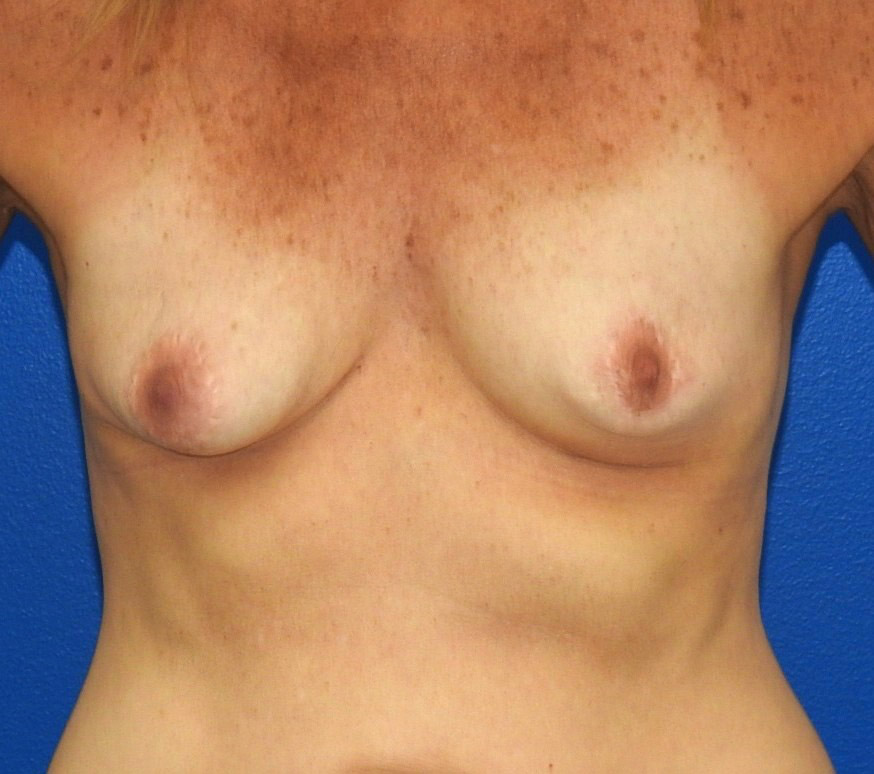 Before Image: Patient Case #0204 - front