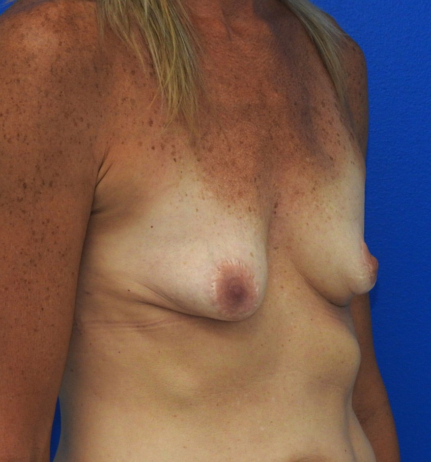 Before Image: Patient Case #0204 - right-front-oblique